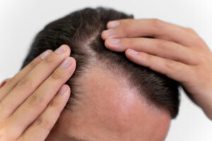 Read more about the article Is there a difference between male and female hair loss?