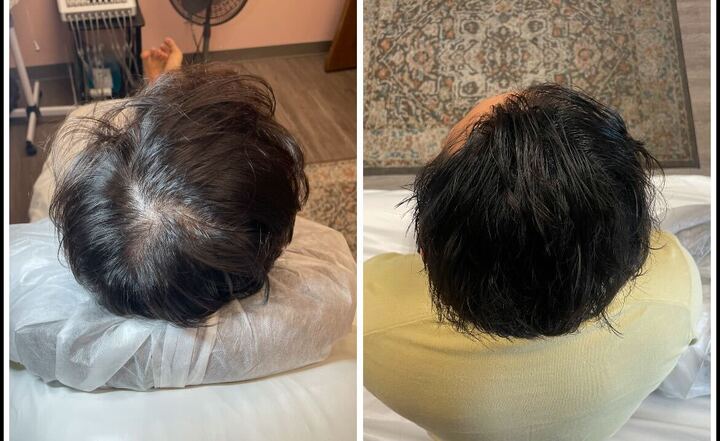 Treatment System #1 | Platinum Advance Hair Restoration - Image 3