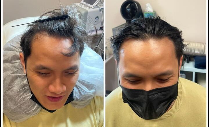 Treatment System #1 | Platinum Advance Hair Restoration - Image 5