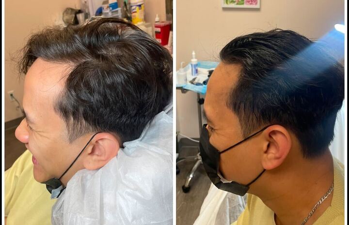 Treatment System #1 | Platinum Advance Hair Restoration - Image 4