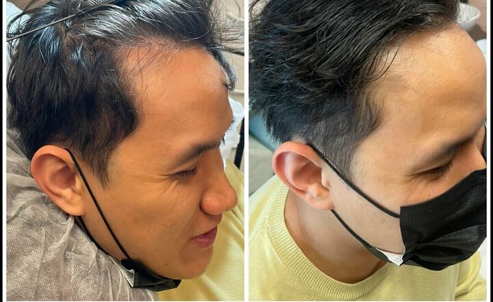 Treatment System #1 | Platinum Advance Hair Restoration - Image 2